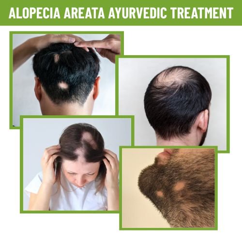 alopecia areata medicine, penukurukudu