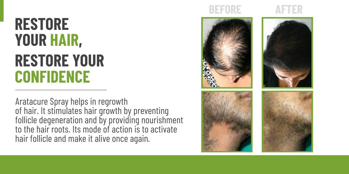 SBH Alopecia Areata spray Medicine