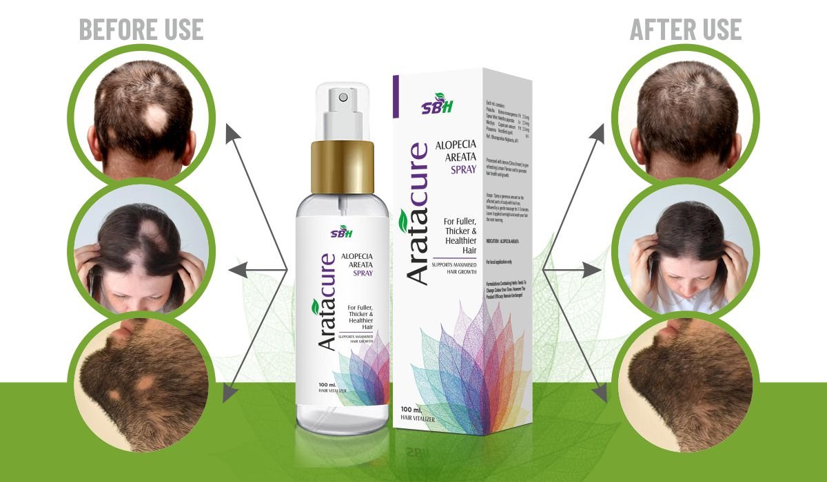 SBH Alopecia Areata spray Medicine