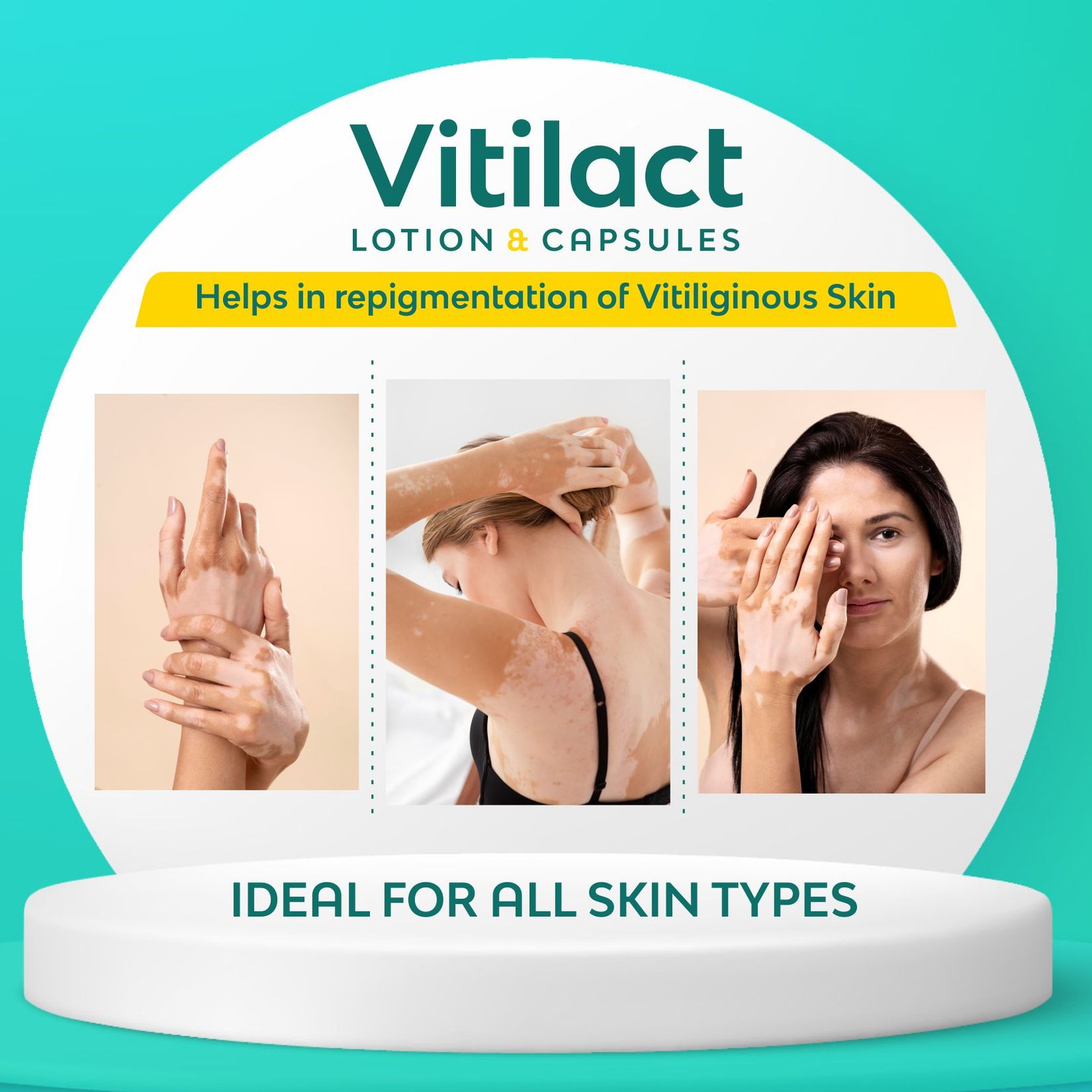 <b>Vitilact Combo</b> (100 ml lotion & 60 capsules) Ayurvedic, powerful & trusted formulation for faster and effective repigmentation of white patches (Vitilgo) - Image 3