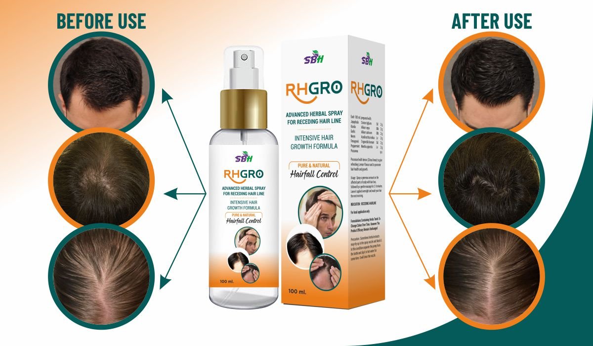 SBH Alopecia Areata spray Medicine