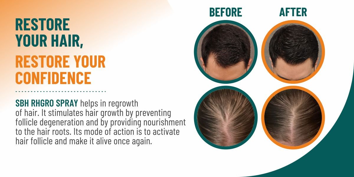 SBH Alopecia Areata spray Medicine