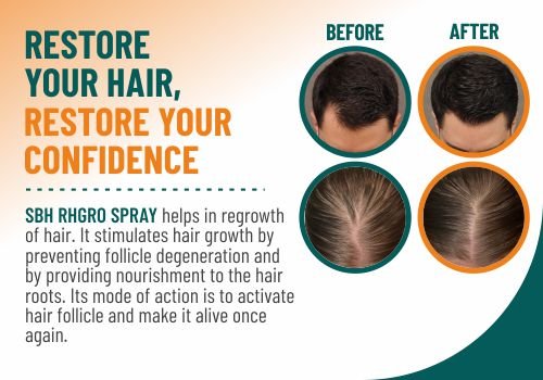 SBH Alopecia Areata spray Medicine